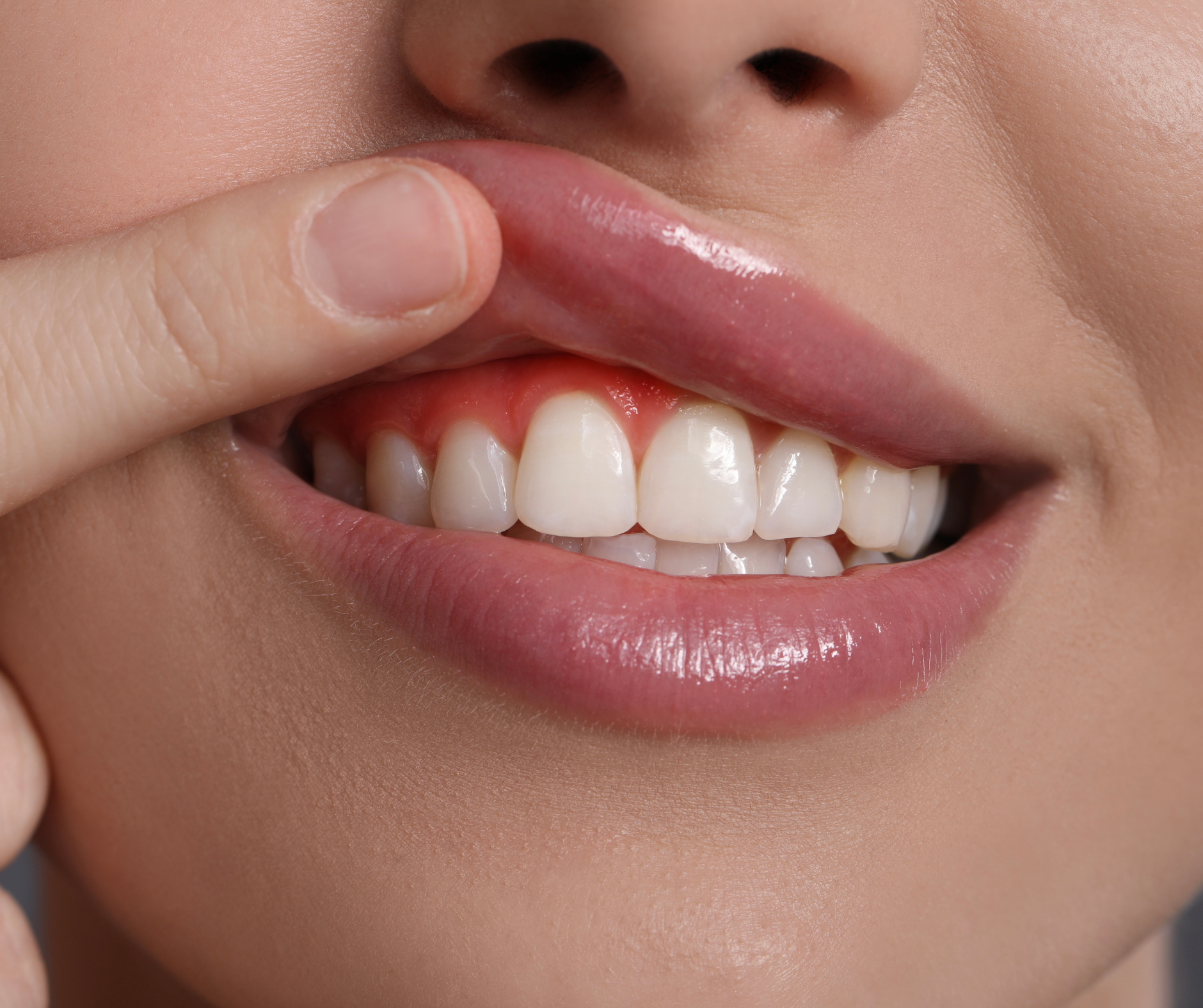 GUMMY INJECTIONS